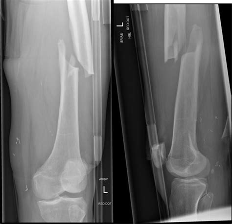 Atypical bilateral femoral fractures: a rare adverse effect of long ...