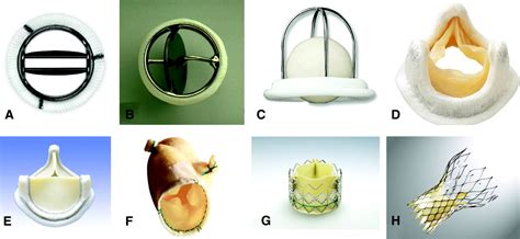 Prosthetic Heart Valves | Circulation