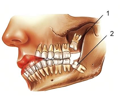 Wisdom Teeth Removal in Sydney - Sydney Dental Surgeons