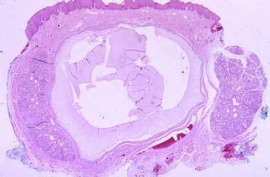 Mucocele Histology