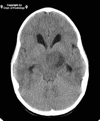 Neuroradiology On the Net: Pilocytic astrocytoma