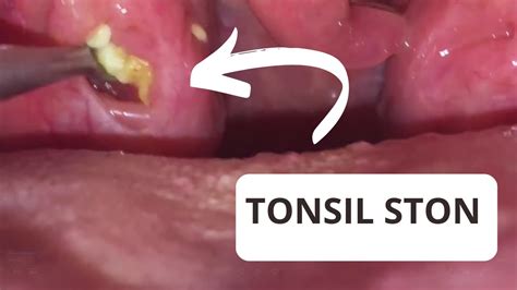 TONSIL STONES Removal | Extracción de TONSILOLITOS - YouTube