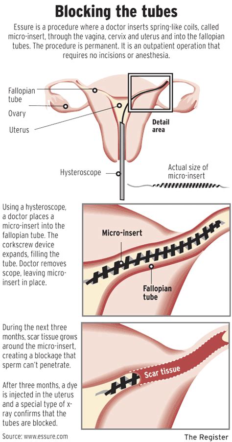 Essure Sterilization | Human Sexuality Wiki | Fandom powered by Wikia