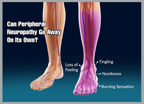 Does Neuropathy from Chemo Go Away? | Berkeley Institute International