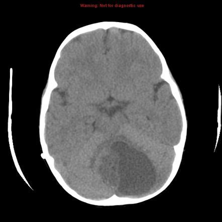 Pilocytic astrocytoma | Radiology Case | Radiopaedia.org