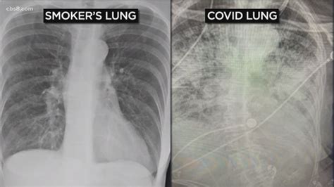 Healthy Lungs Vs Smokers Lungs X Ray