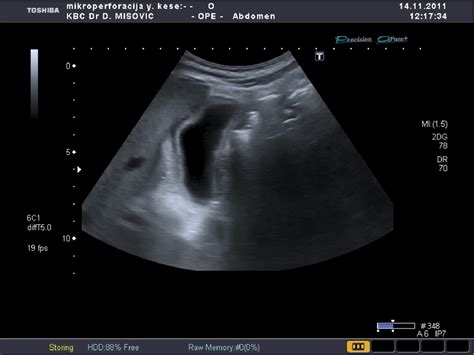 Gallbladder perforation - radiological aspects, types and causes ...