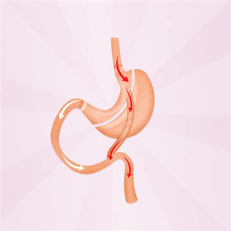 Home : Treatments : Obesity Surgery (bariatric Surgery) : Loop Duodenal ...