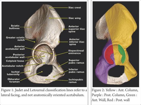 Digastric Trochantric Flip OsteDigastric Trochantric Flip Osteotomy ...