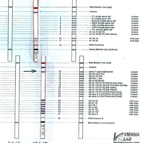 Hemoglobin electrophoresis results from the patient's parents (mother ...