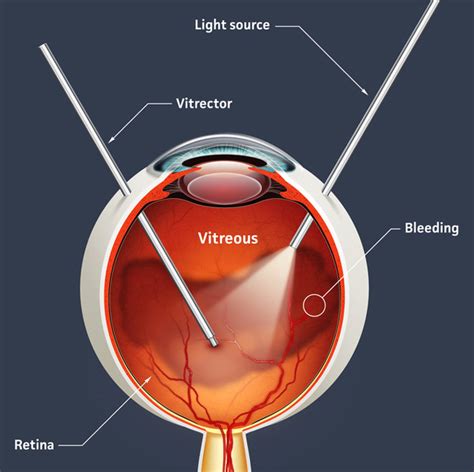 What is Pars Plana Vitrectomy? | New Health Advisor