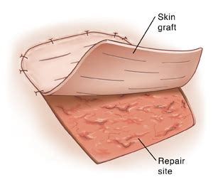 Skin Graft Surgery | Saint Luke's Health System