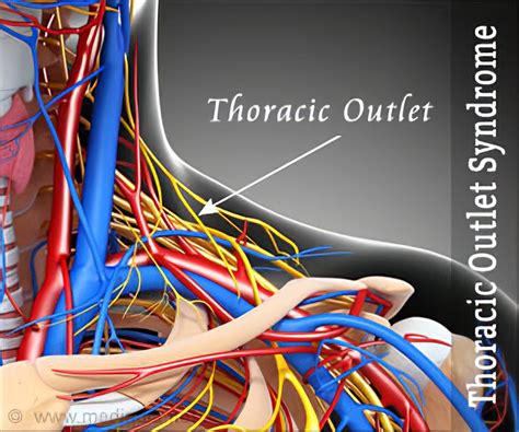 Thoracic Outlet Syndrome - Symptoms Diagnosis Treatment Remedies