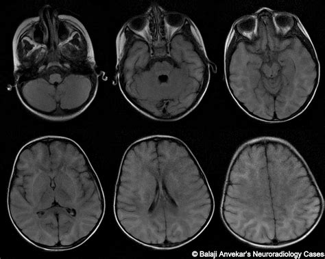 Brain Lesions: Brain Lesions With Restricted Diffusion