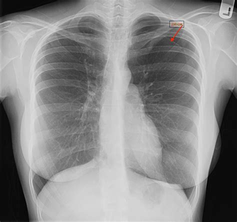 Cureus | Left-sided Catamenial Pneumothorax: A Rare Clinical Entity