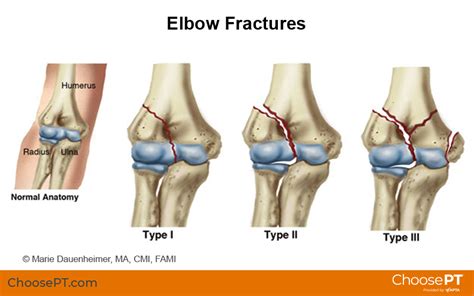 Guide | Physical Therapy Guide to Elbow Fracture | Choose PT