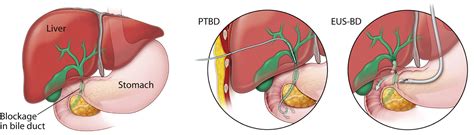 How Long Do Biliary Drains Stay In - Best Drain Photos Primagem.Org