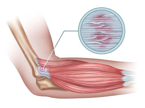 Why We’re Often Failing Our Lateral Epicondyle Patients – Physiospot ...