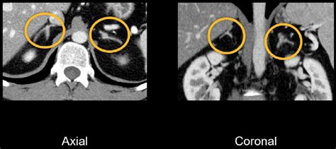 Abdominal CT: spleen and adrenal glands • LITFL • Radiology