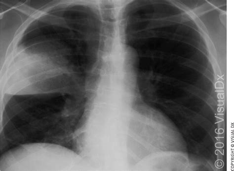 Community-Acquired Pneumonia in Adults: Diagnosis and Management | AAFP