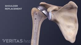 Reverse Shoulder Replacement Risks and Complications | Arthritis-health