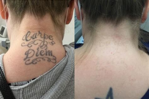 Everything You Need To Know About Tattoo Removal Before And After ...