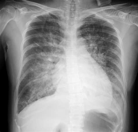 Pulmonary Edema Chest X Ray