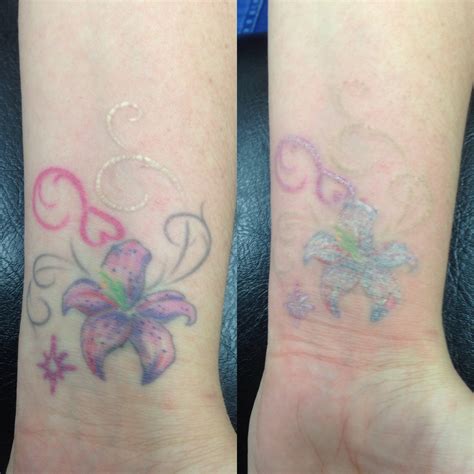 Laser Tattoo Removal Before & After Photos Birmingham