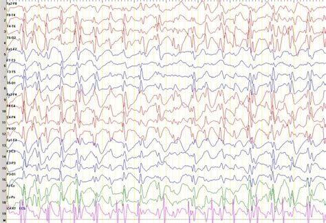 Standard EEG - Entabeni Epilepsy Laboratory