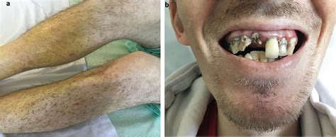 Images of the month 1: ‘The scurvy’ – diagnosis by gestalt | RCP Journals