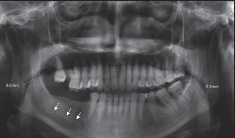 How to Diagnose Mandibular Canal Enlargement