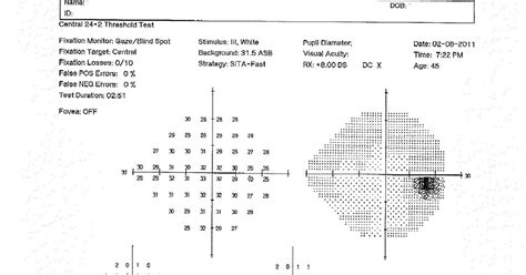 中醫眼科 Blog: Case study of Acute zonal occult outer retinopathy (AZOOR ...