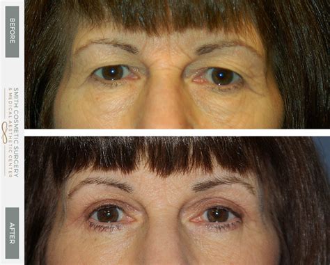 Eyelid Lift Denver | Brow Lift | Eyebrow Lift | Eyelid Surgery