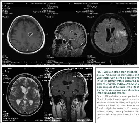 Invasive primary intracerebral infections in women caused by ...