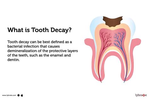 Cavities (Tooth Decay): Symptoms, Causes & Treatment - weheartanimals.info