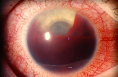 Hyphema causes, symptoms, grading, complications, recovery & treatment