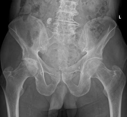 Osteoarthritis of the hip | Radiology Reference Article | Radiopaedia.org