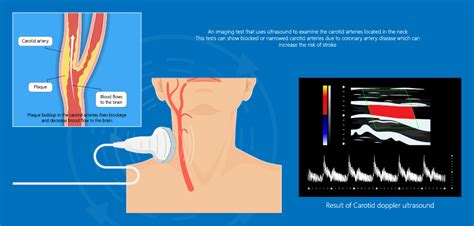 Carotid Doppler Ultrasound