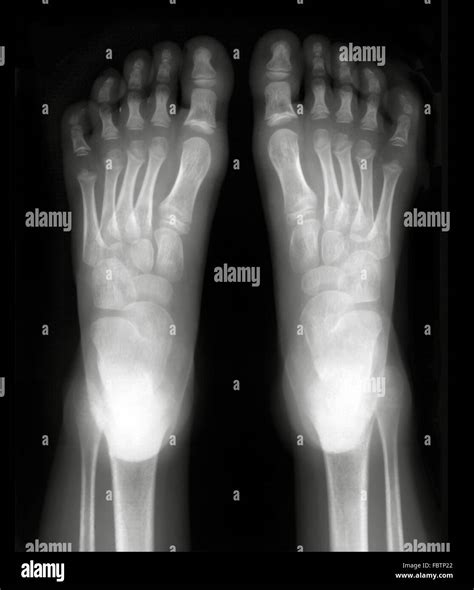 Foot Xray Anatomy