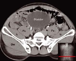 Abdominal CT anatomy | Radiology Key