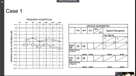 How To Read An Audiogram Video : How To Read An Audiogram Youtube : In ...