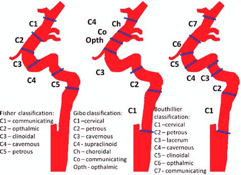 Classifi cation of ICA segments according to Fisher, Gibo, Bouthillier ...