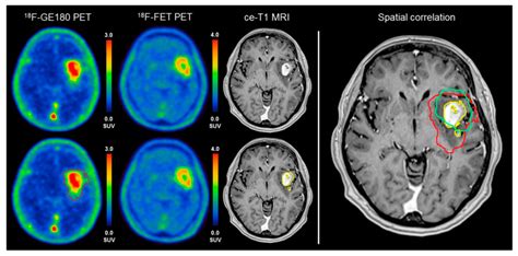 Diagnostics | Free Full-Text | Molecular Imaging of Brain Tumor ...