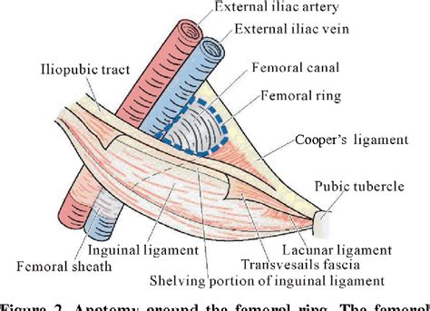 Figure 2 from Femoral Hernia : A Review of the Clinical Anatomy and ...