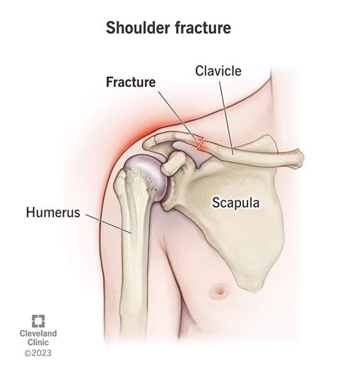 Shoulder Fracture: Symptoms, Treatment & Recovery