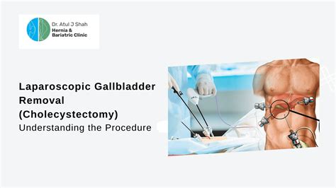 Laparoscopic Gallbladder Removal (Cholecystectomy): Understanding the ...