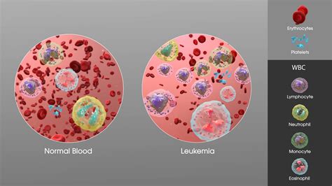 Leukemia - Types, Causes, Symptoms, Diagnosis, Treatment, Prevention ...