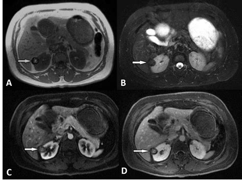 Cureus | A Concise Review of the Multimodality Imaging Features of ...