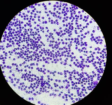 SYNOVIAL FLUID ANALYSIS