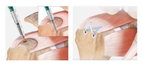 Rotator Cuff Tears | Dr. Edward S. Chang, MD